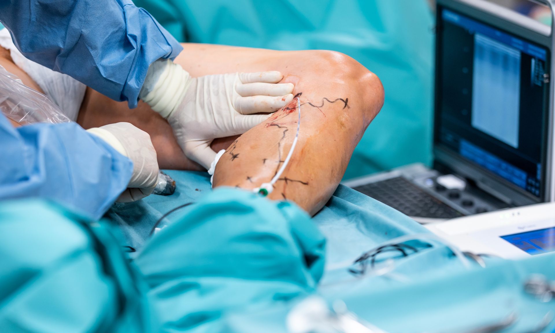 varicose veins diagnosis